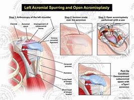 Image result for acromial