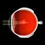 Image result for Myopia Vision