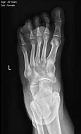 Image result for Kaposi Sarcoma Foot