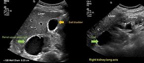 Image result for Mid Pole Kidney Complex Cyst