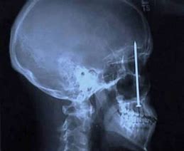 Image result for Funny X-ray of Brain in Knee