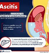 Image result for ascitis