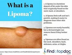 Image result for Lump Under Skin On Stomach
