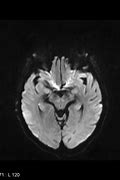 Image result for Transient Global Amnesia