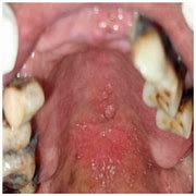 Image result for Oral HPV Tongue
