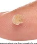 Image result for Treatment for Warts