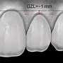 Image result for Gingival Zenith