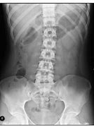 Image result for Back Stretching X-ray