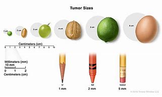 Image result for Tumor Sizes in Centimeters