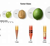 Image result for How Big Is a 2 5 Cm Tumor