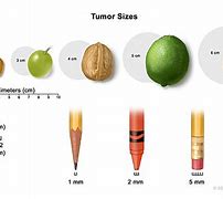 Image result for How Big Is 7 Cm Tumor