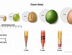 Image result for How Big Is a 20 Cm Tumor