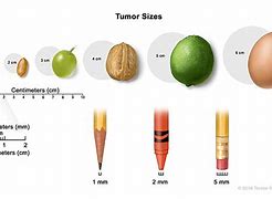 Image result for 9Mm Tumor Image Size