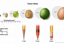 Image result for 6 Cm Tumor Picture