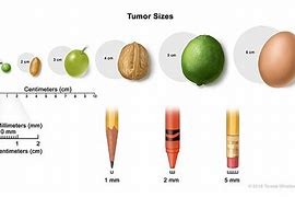 Image result for How Big Is 9 Cm Tumor