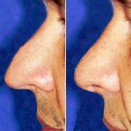 Image result for Nose Bridge Collapse