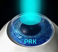 Image result for PRK Eye