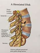 Image result for Lumbar Spine Disc Herniation