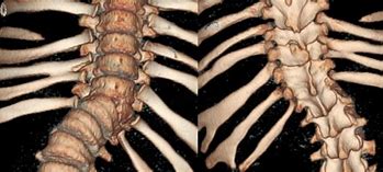 Image result for Vertebrae Fusion Surgery