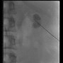 Image result for Nephrostomy Catheter Exchange