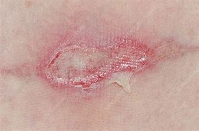 Image result for Burn Looks Infected