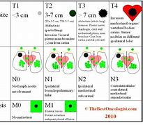 Image result for Lung Tumor Size