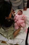 Image result for Baby Born with Anencephaly
