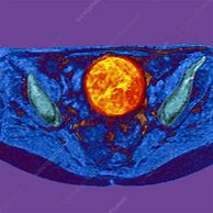 Image result for Ovarian Cancer MRI