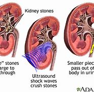Image result for Kidney Full of Stones