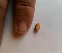 Image result for What Size Is a 7Mm Kidney Stone