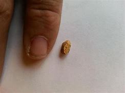 Image result for 7 Millimeter Kidney Stone