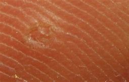 Image result for Wart Bottom of Foot Treatment