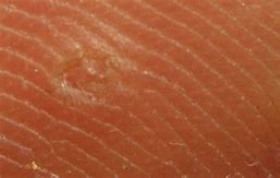 Image result for Plantar Wart Core Removal