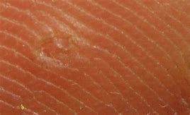 Image result for Warts On Foot Bottom