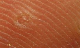 Image result for Baby Warts