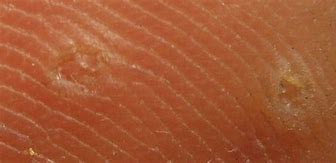 Image result for Skin Cancer Warts