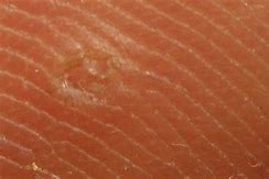Image result for Wart and Mole Vanish