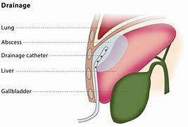 Image result for Types of Pigtail Catheter