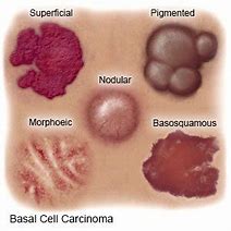 Image result for Basal Cell Mole