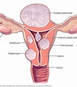 Image result for Posterior Fibroid