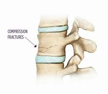 Image result for Compression Fracture Lumbar Spine