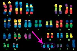 Image result for 21st Chromosome