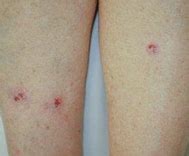Image result for Basal Cell Carcinoma Lower Leg