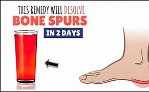 Image result for How to Remove Bone Spurs On Back of Ankle