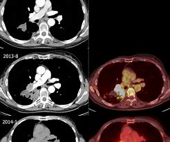 Image result for Metastatic Lung Cancer
