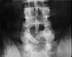 Image result for Spina Bifida Occulta Radiology