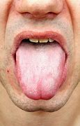 Image result for Yeast Infection On Tongue