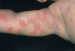 Image result for Baby Food Allergy Rash