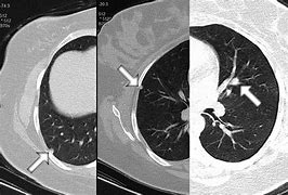 Image result for Calcified vs Noncalcified Lung Nodules