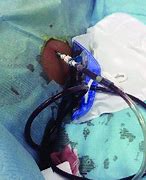 Image result for Percutaneous Catheter Drainage